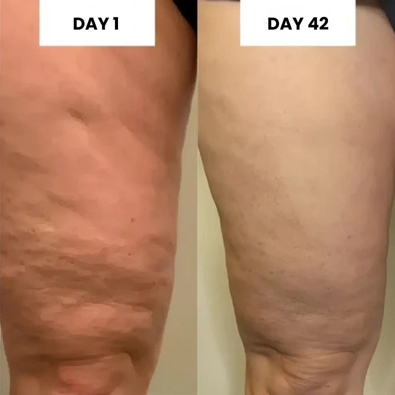 GlowCup – Cellulite and Skin Tightening with Red Light and Cupping